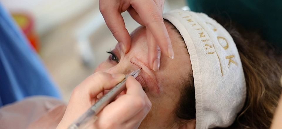 Long Hair FUE eyebrow transplant procedure