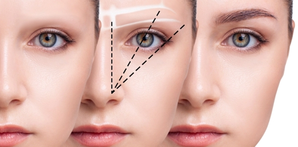 FUT Eyebrow Transplant Nape Scar: The 3 Differences of a Stitchless Removal
